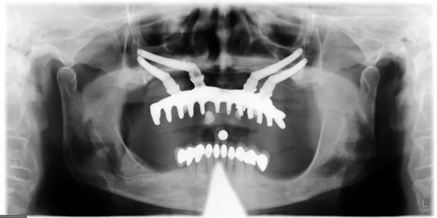 impianti dentali inclinati