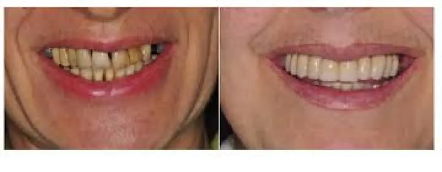 Sottoporsi ad un intervento di implantologia dentale