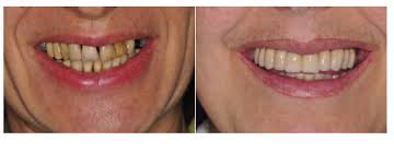 Sottoporsi ad un intervento di implantologia dentale