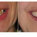 Sottoporsi ad un intervento di implantologia dentale