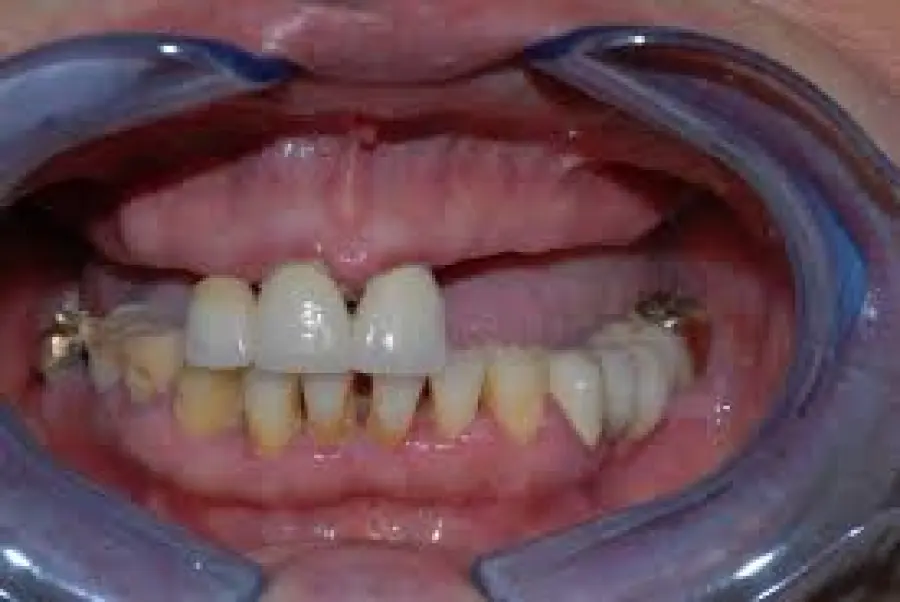 Interventi di chirurgia di precisione di implantologia dentale Milano