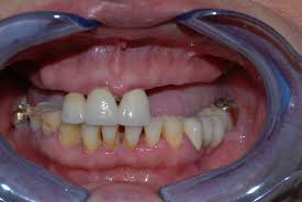 Interventi di chirurgia di precisione di implantologia dentale Milano