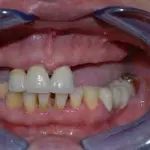 Interventi di chirurgia di precisione di implantologia dentale Milano