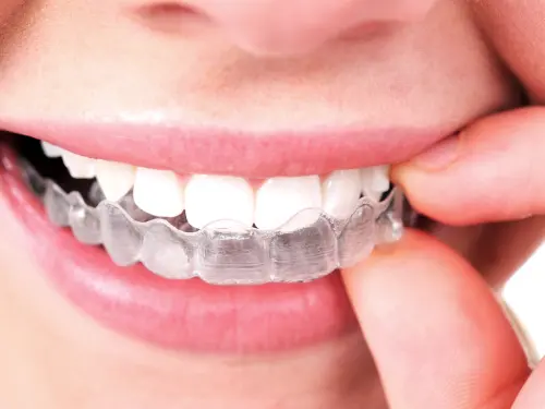 Invisalign quanto costa?