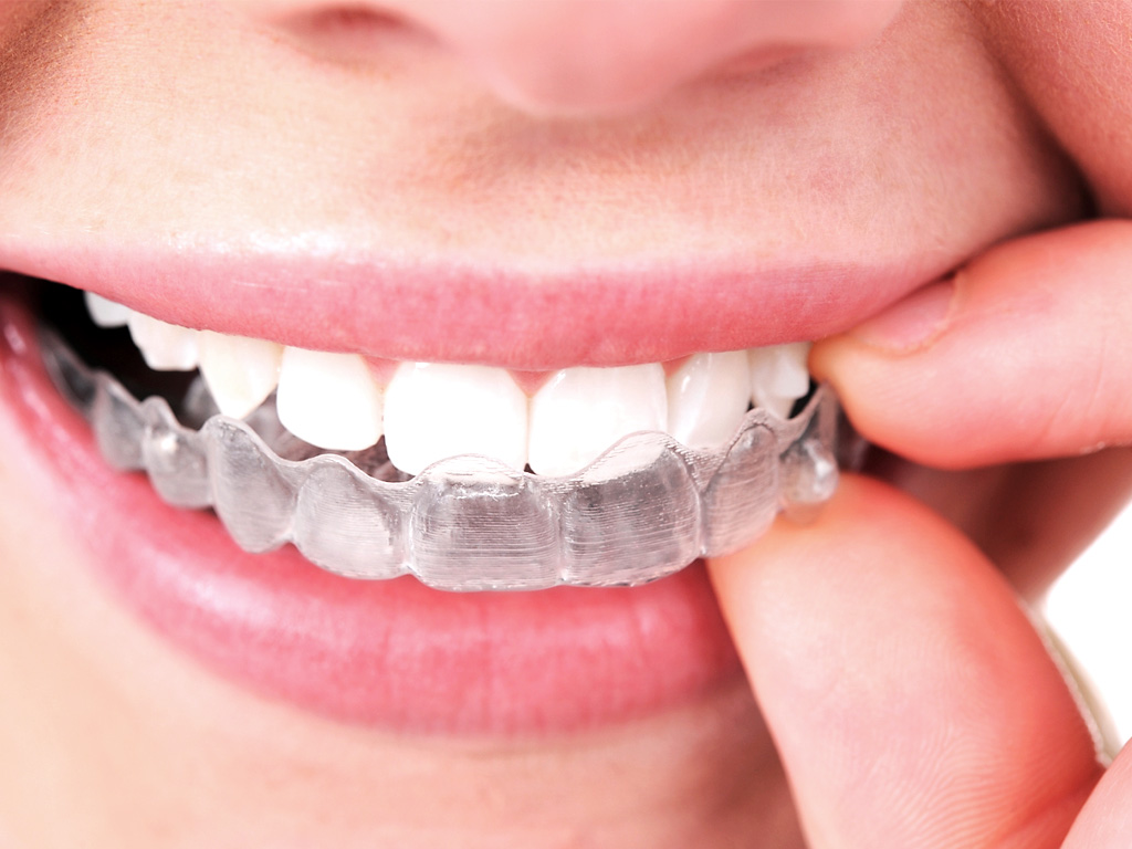 Invisalign quanto costa?