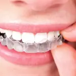 Invisalign quanto costa?