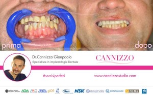 denti fissi subito